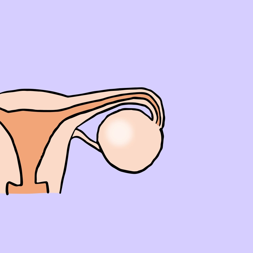 포궁내막증 (자궁내막증)